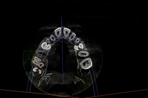 CT image of the teeth of a 9-year-old child, with baby teeth, in different .. Stock Photos