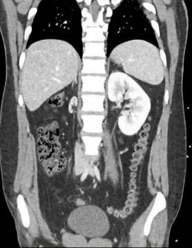 CT Imaging of Hypoplastic Right Kidney  1 Stock Photos
