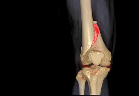 CT knee 3D rendering image AP view isolated on black background showing fract Stock Illustration