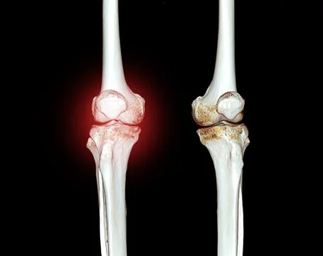CT knee 3D rendering image Stock Illustration
