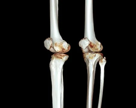 CT knee 3D rendering image Stock Illustration