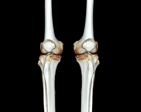 CT knee 3D rendering image Stock-Illustration