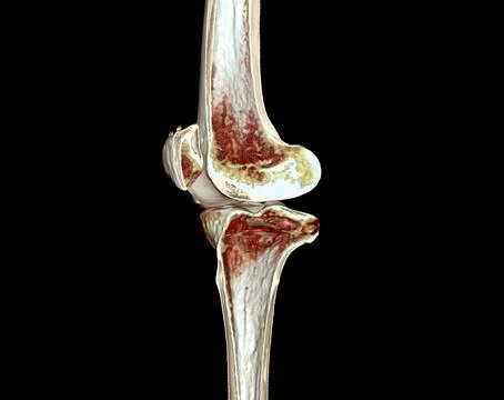 CT knee 3D rendering image Illustrazione stock