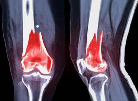 CT knee joint Coronal and Sagittal view isolated on black background showing Stock Illustration