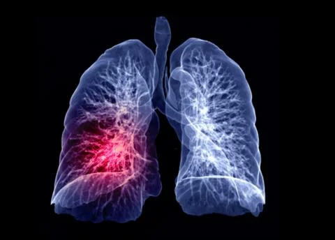 CT lung 3d rendering imag Illustrazione stock