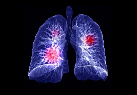 CT lung 3d rendering imag Stock Illustration