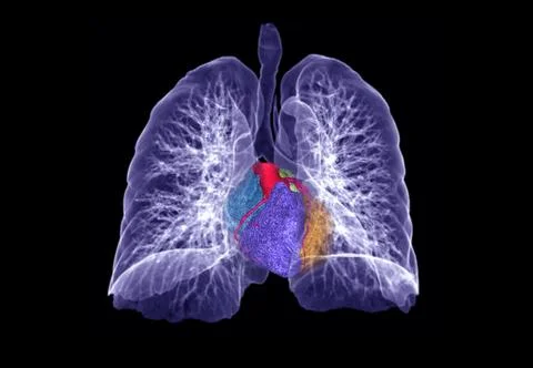 CT lung 3d rendering imag Stock Illustration