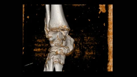 Ct scan 3D Ankle joint views A woman 64 year old accident showing Spiral frac Stock Footage 158902119