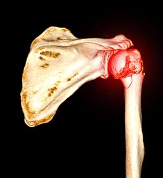 CT scan 3D rendering of Left shoulder showing fracture head of humerus . Stock Illustration