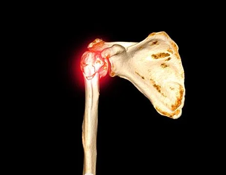 CT scan 3D rendering of  shoulder joint showing fracture head of humerus . Stock Illustration