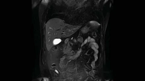 CT scan of the abdomen. Computed tomography of the gastrointestinal tract, liver Stock Footage 166346813