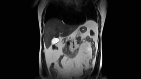 CT scan of the abdomen. Computed tomography of the gastrointestinal tract, liver Stock Footage 166625244