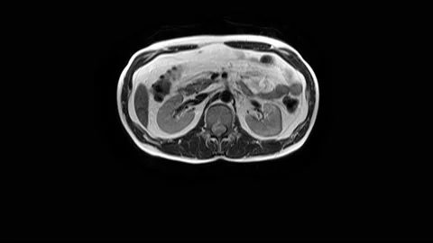 CT scan of the abdomen. Computed tomography of the gastrointestinal tract, liver Stock Footage 166738840