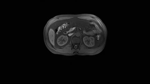 CT scan of the abdomen. Computed tomography of the gastrointestinal tract, liver Stock Footage 167196460