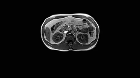 CT scan of the abdomen. Computed tomography of the gastrointestinal tract, liver Stock Footage 167276137