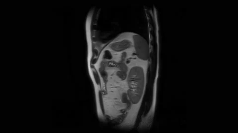 CT scan of the abdomen. Computed tomography of the gastrointestinal tract, liver Stock Footage 167303276