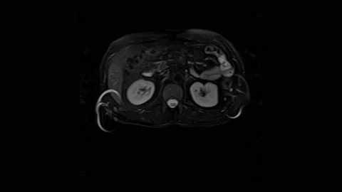 CT scan of the abdomen. Computed tomography of the gastrointestinal tract, liver Stock Footage 167360199