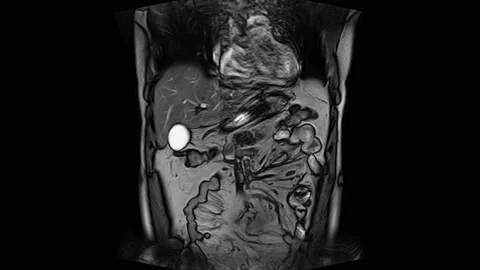 CT scan of the abdomen. Computed tomography of the gastrointestinal tract, liver Stock Footage 172194705