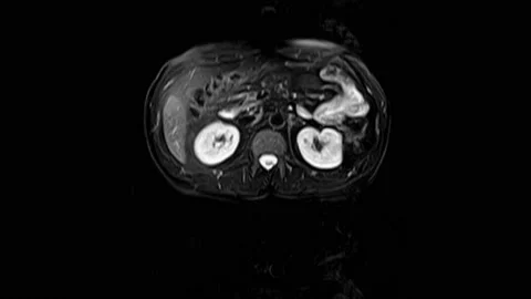 CT scan of the abdomen. Computed tomography of the gastrointestinal tract, liver Stock Footage 172194807
