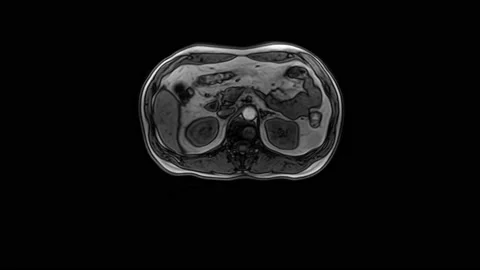 CT scan of the abdomen. Computed tomography of the gastrointestinal tract, liver Stock Footage 172576896