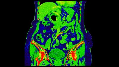 CT scan of  Abdomen  coronal view with injection contrast media with green .. Stock Illustration