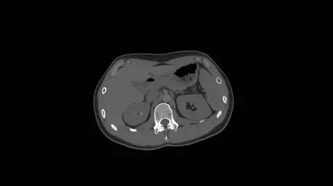CT scan of abdomen Stock Footage 44420722