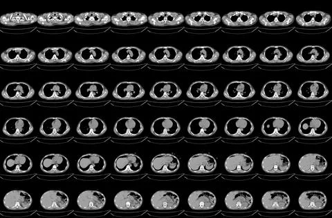 CT scan abdomen of the patient's Diffuse bronchial wall thickening and mild.. Stock Photos