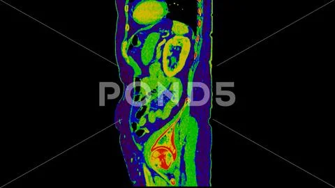 CT scan of Abdomen sagittal view with injection contrast media with ...