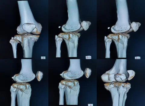 CT scan and 3D computer rendering image of a knee of the patient suffering fr Stock Photos