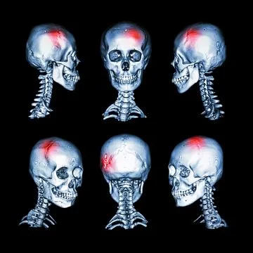 CT scan and 3D image of head and cervical spine . Use this image for stroke.. Stock Illustration