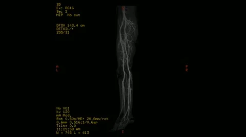CT scan - angiography of legs arteriae Stock Footage 44752591