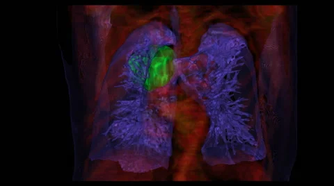 CT scan animation showing a large lung cancer in the right upper lobe Video stock 64804447