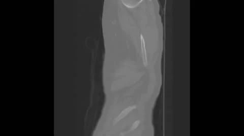 CT scan animation showing a large lung cancer in the right upper lobe Vidéo 64804451