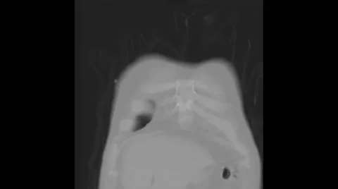 CT scan animation showing a large lung cancer in the right upper lobe 스톡 동영상 64804452