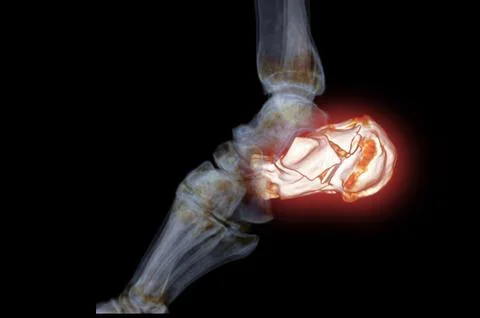 CT Scan ankle joint with  3d rendering of calcaneus bone showing Calcaneus .. Stock Illustration