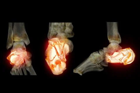 CT Scan ankle joint with  3d rendering of calcaneus bone showing Calcaneus .. Illustrazione stock