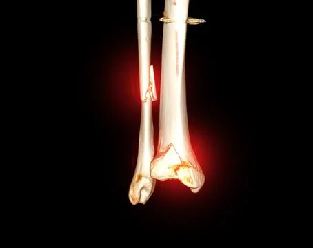 CT Scan ankle joint  3D  Rendering image showing fracture tibia and fibula .. Stock Illustration
