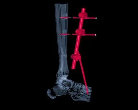 CT Scan ankle joint  3D  Rendering image showing fracture tibia and fibula .. Illustrazione stock