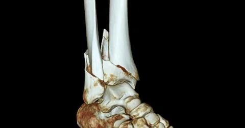 CT Scan ankle joint  3D  Rendering image showing fracture tibia and fibula .. Stock Photos