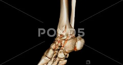 CT Scan ankle joint or Computed Tomography of Ankle joint 3D Rendering ...