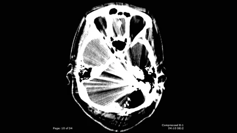 CT scan axial view with bullet fragmentation in brain male 20 year old Stock Footage 132925361