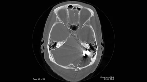 CT scan axial view with bullet fragmentation in brain male 20 year old Stock Footage 132926426