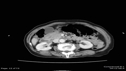 CT scan Axial view with contrast for diagnosis Abdominal aortic aneurysm 4k Stock Footage 132629970