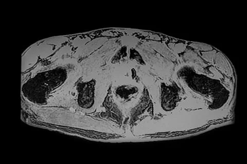 CT- Scan of bladder tumor. Stock Photos