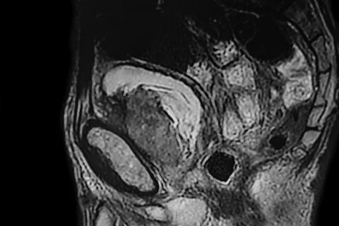 CT- Scan of bladder tumor. Stock Photos