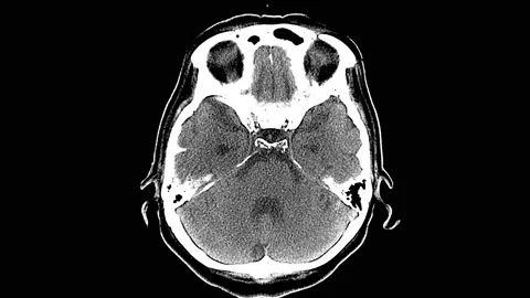 CT scan Brain atrophy Stock Footage 132535295
