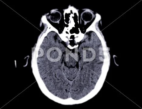 Photograph: CT scan of the brain Axial plane for diagnosis brain tumor ...