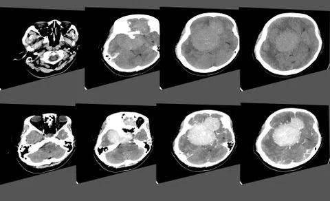 CT Scan Brain Axial scans with 5 mm slice thickness from OM-line to vertex. Stock Photos