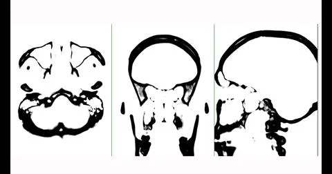 CT scan of the brain axial,coronal and sagittal view  black and white mode. Stock Illustration