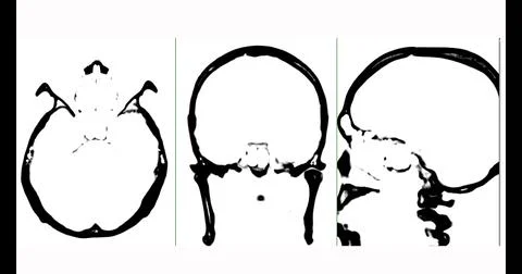 CT scan of the brain axial,coronal and sagittal view  black and white mode. Stock Illustration